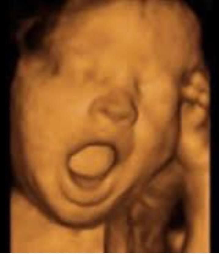 A picture of an infant with a mouth open.