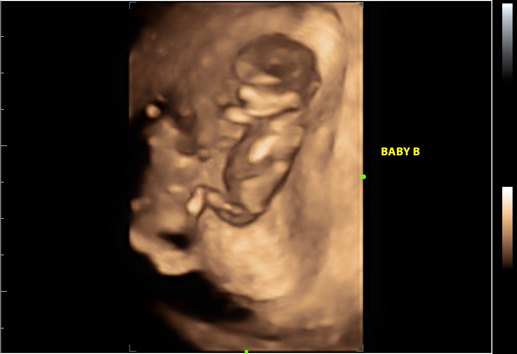 4D sonogram baby on the display of the website