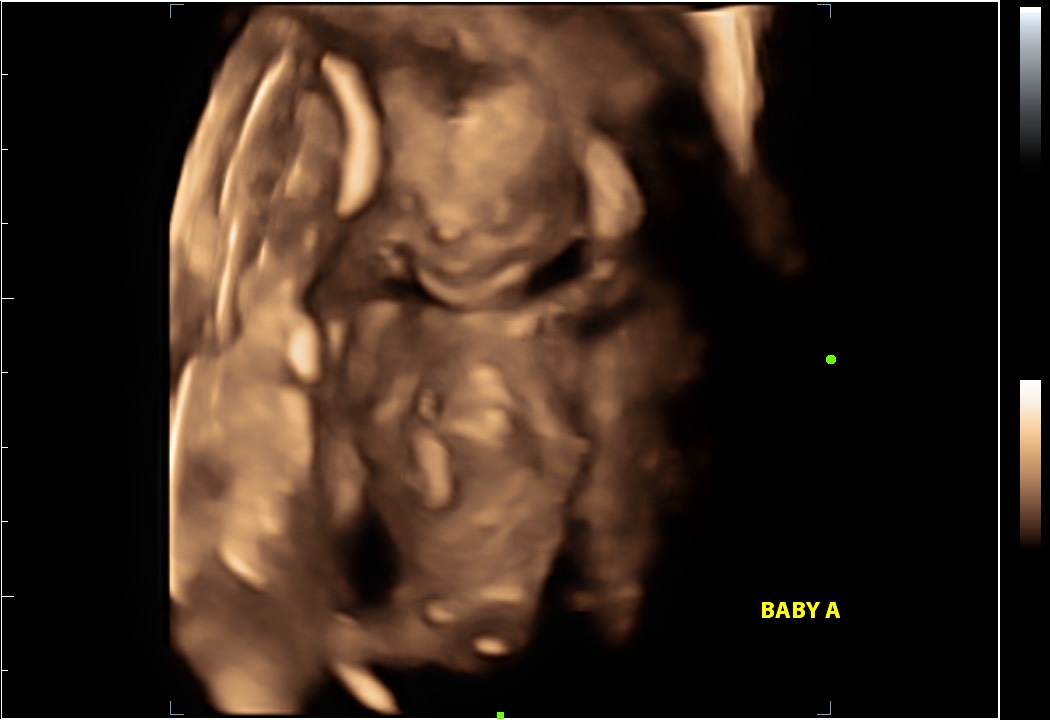 4D ultrasound technology on the display of the website