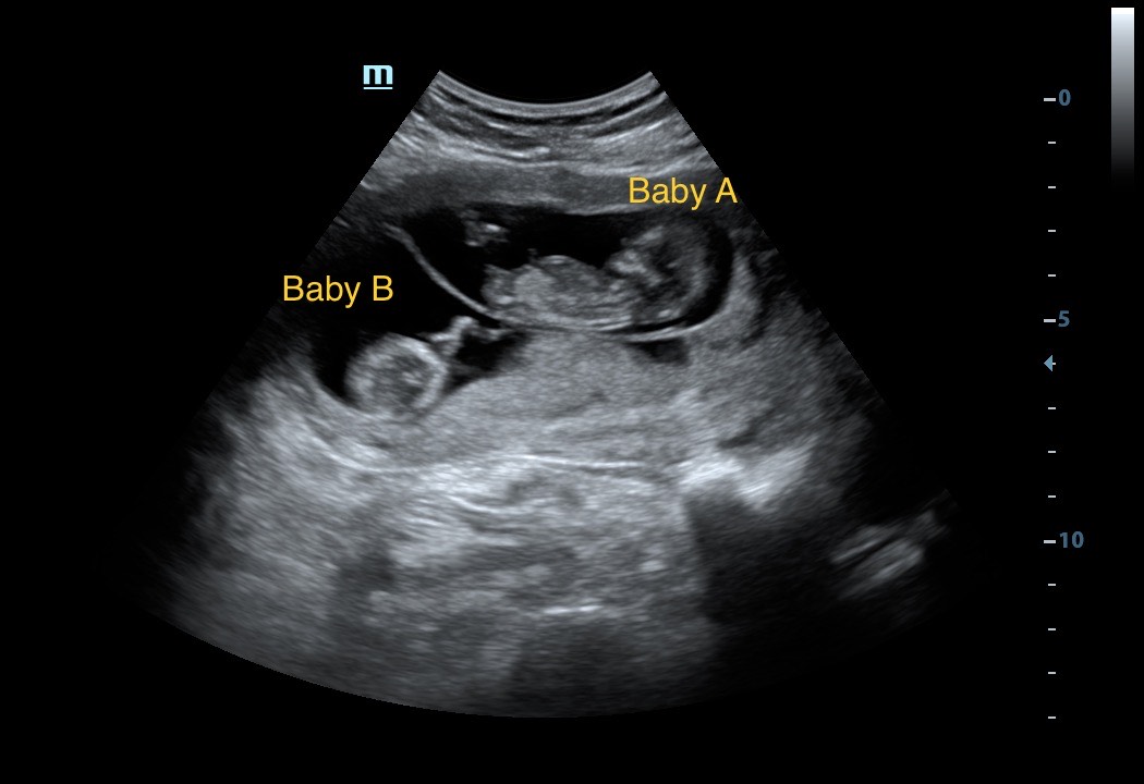 Babys 4D ultrasound view on the display of the website
