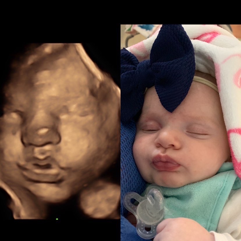 Collage of ultrasound 3d image of baby and born baby