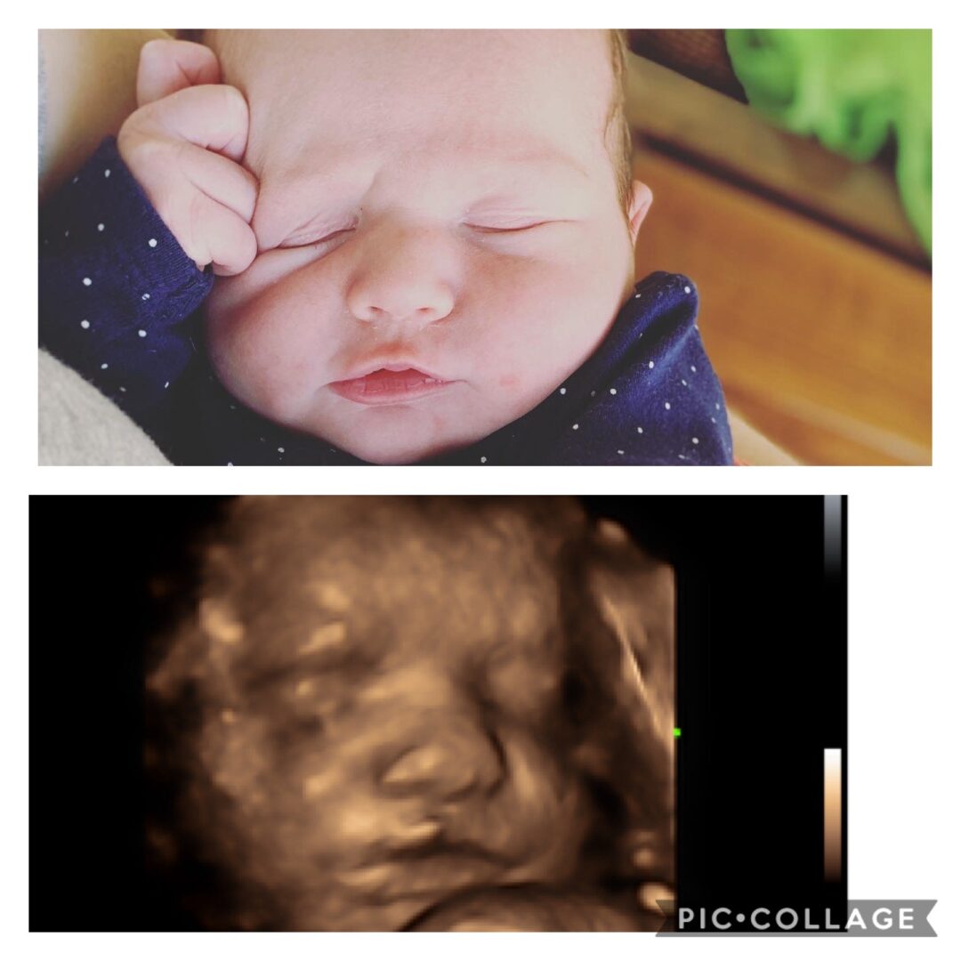 Collage of ultrasound image of baby and new born baby
