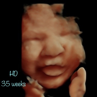 A baby crying with its head down and the text " hd 3 5 weeks ".