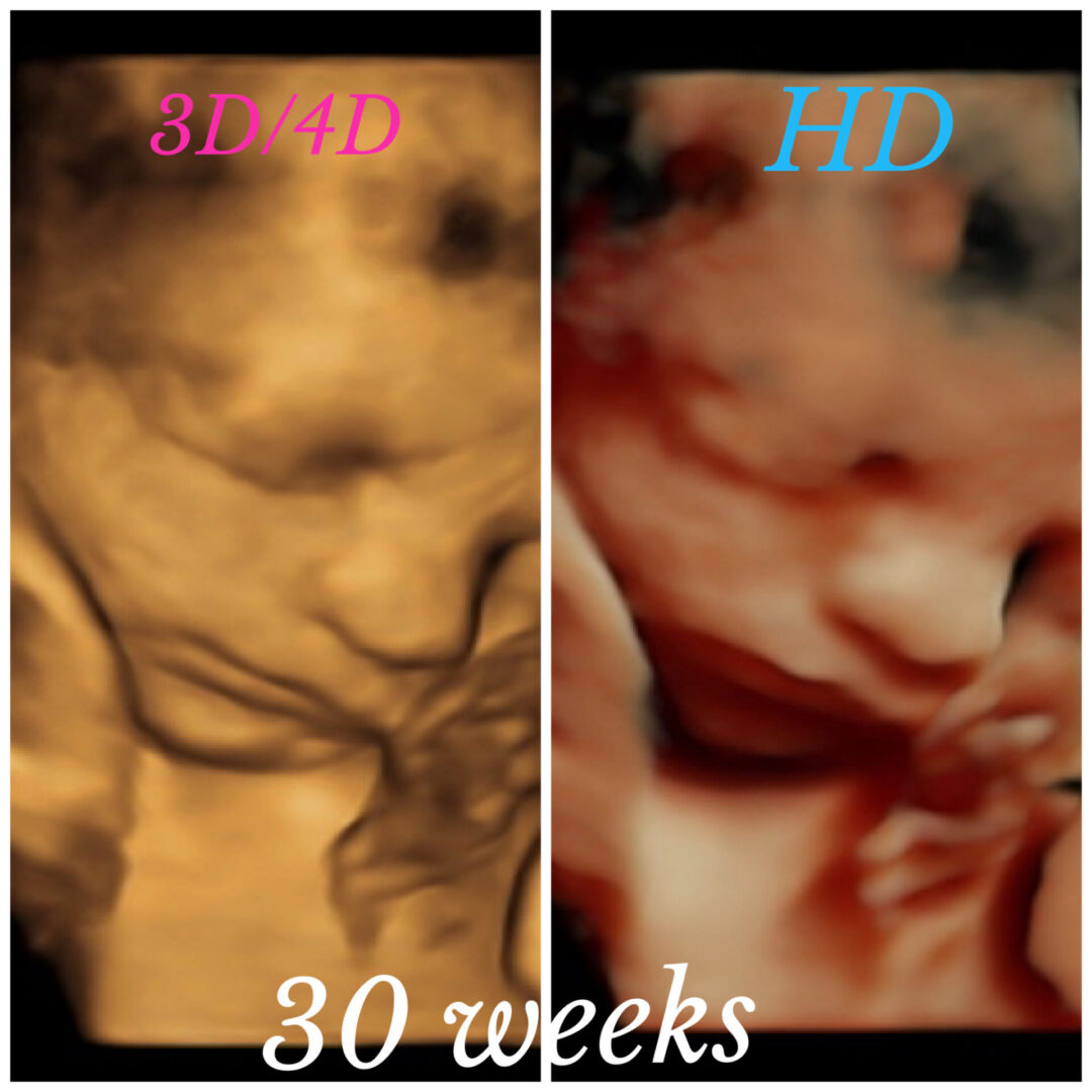 A picture of the same image in 3 0 weeks.
